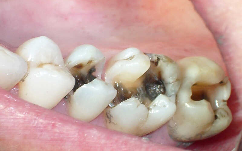 Dấu hiệu dễ dàng để nhận biết sâu răng 