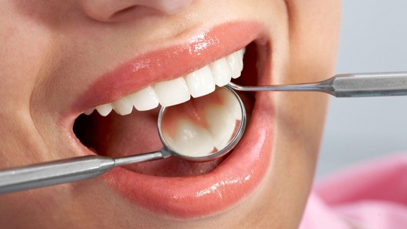 Cách ngăn ngừa và làm sạch cao răng tại nhà hiệu quả
