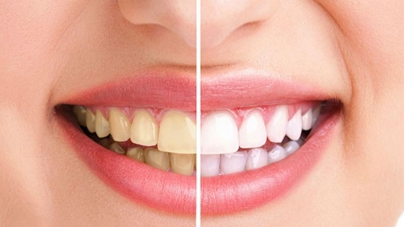 Cao răng có hại như thế nào?