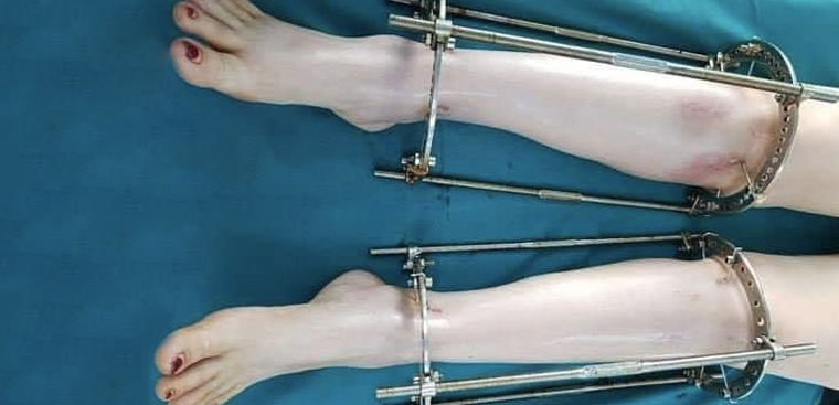 Người nào không nên thực hiện phẫu thuật kéo dài chân ở Mỹ?