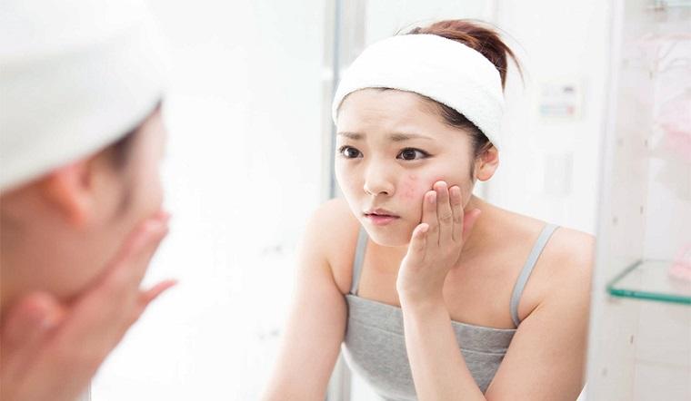 Cách trị mụn trứng cá tại nhà bằng nguyên liệu tự nhiên