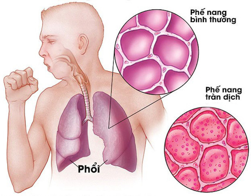 Virus Covid-19 tàn phá cơ thể người bằng cách nào?