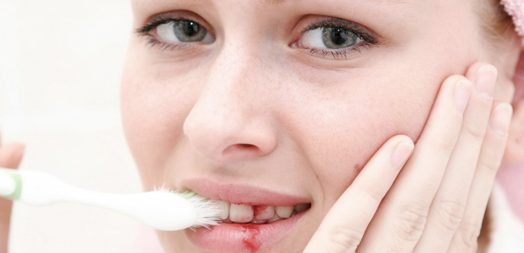 Cách ngừng tác động mạnh đến vùng lợi viêm khi chảy máu chân răng?
