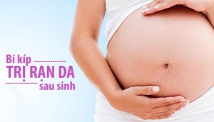 5 phương pháp trị rạn da sau sinh hiệu quả từ các nguyên liệu dễ kiếm