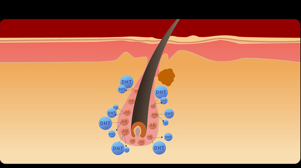 Việc chuyển đổi Dihydrotestosterone từ Testosterone nội tiết tố nam là thủ phạm chính gây ra rụng tóc nhiều nhất