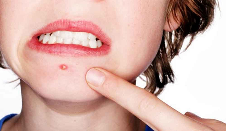 Mụn nhọt là gì? những điều chưa biết về mụn nhọt 
