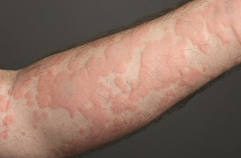 9 bệnh da liễu thường gặp trong mùa nồm và cách ngăn ngừa