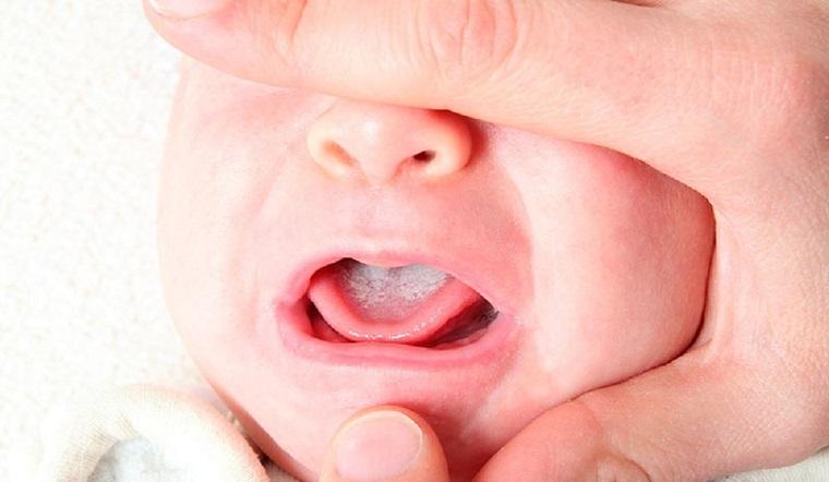 Tưa lưỡi là gì?