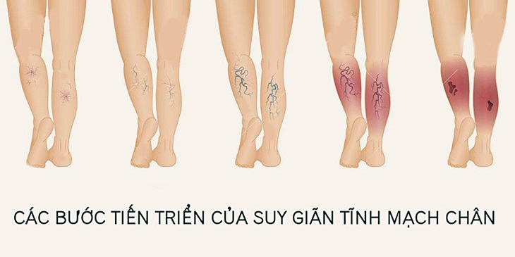 Ngăn ngừa giãn tĩnh mạch