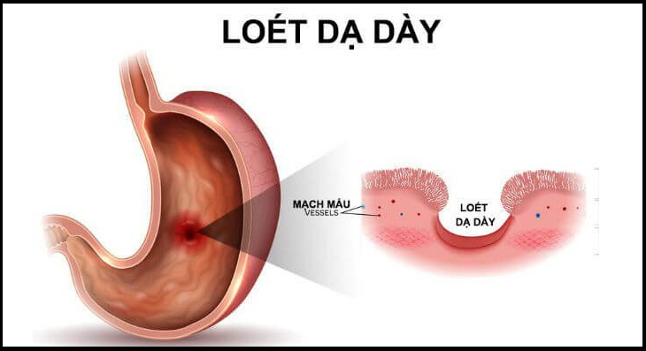 Cải thiện tình trạng loét dạ dày