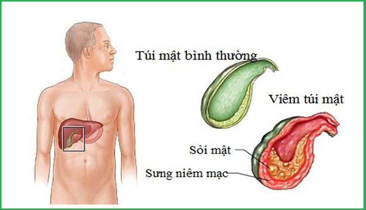 Hỗ trợ điều trị các bệnh liên quan đến thận và túi mật