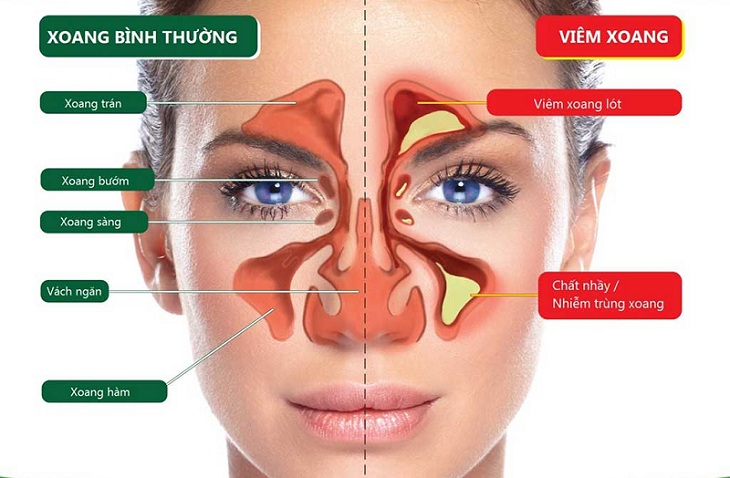 Bị viêm xoang có ngồi phòng máy lạnh được không? Cách sử dụng máy lạnh đối với người bị viêm xoang