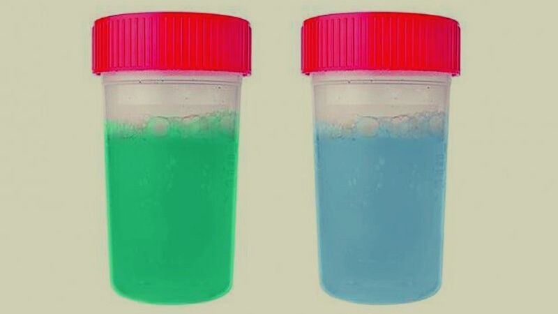 Nước tiểu có màu xanh lam hoặc xanh lục có thể do: màu thực phẩm, sử dụng thuốc,...