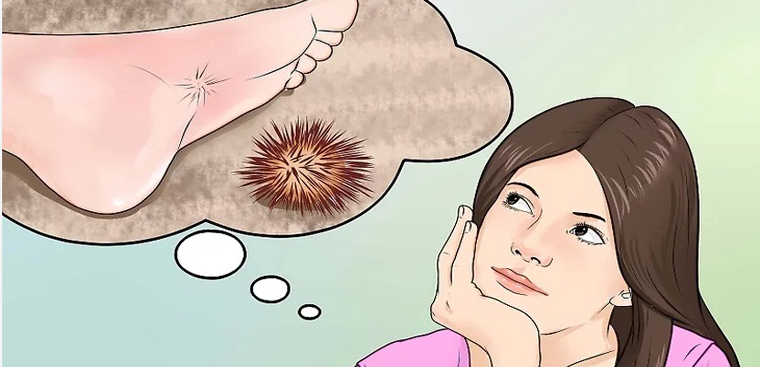 Sơ cứu khi bị nhum, nhím biển cầu gai đâm vào da