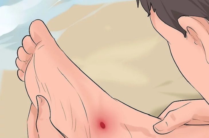 Những lưu &yacute; khi bị gai nhum biển đ&acirc;m v&agrave;o ch&acirc;n