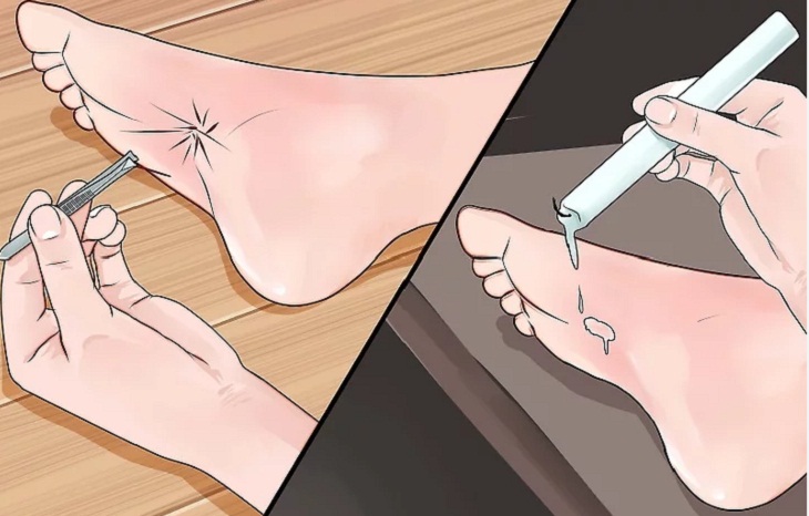 Nhổ bỏ gai của nhum biển.