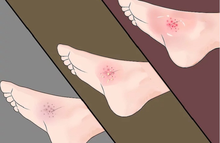 Ch&uacute; &yacute; dấu hiệu vi&ecirc;m nhiễm nặng.