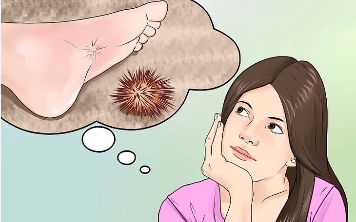 X&aacute;c định vết đ&acirc;m do nhum biển g&acirc;y ra.