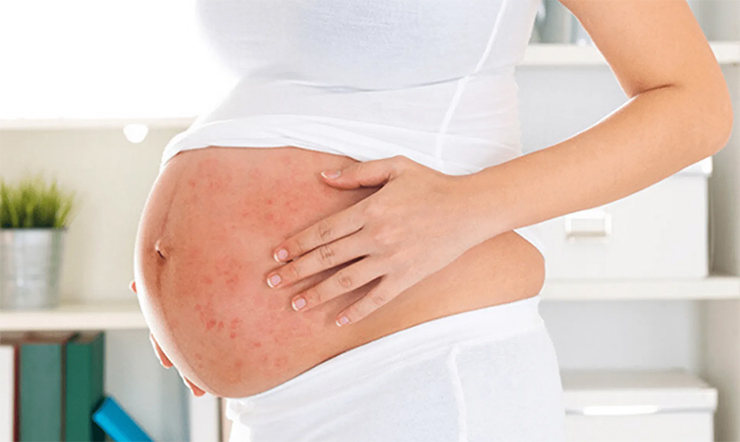 Bà bầu bị dị ứng hải sản có nguy hiểm không? Phải xử lý thế nào để an toàn cho mẹ và bé?