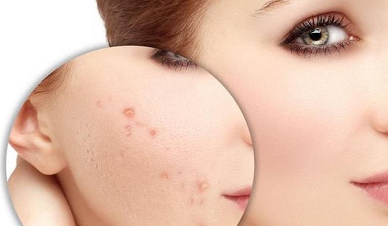 5 nguyên tắc khi điều trị thâm mụn siêu hiệu quả tại nhà
