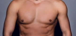 Các dấu hiệu nhận biết và nguyên nhân gây ung thư vú ở nam giới