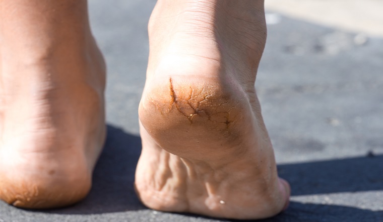 Bị nứt gót chân: Nguyên nhân, triệu chứng, cách trị hiệu quả