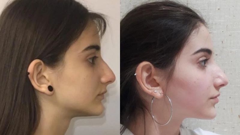 Tập Mewing giúp cải thiện đường nét khuôn mặt