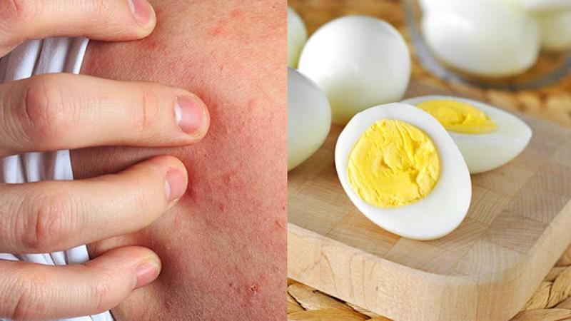 Việc dị ứng này thường khởi phát từ lúc bạn còn nhỏ Việc dị ứng này thường khởi phát từ lúc bạn còn nhỏ