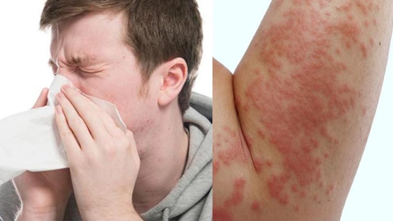 Hãy để ý đến các loại thức ăn mà bạn tiêu thụ để xem mình có phản ứng dị ứng gì với chúng không? Hãy để ý đến các loại thức ăn mà bạn tiêu thụ để xem mình có phản ứng dị ứng gì với chúng không?