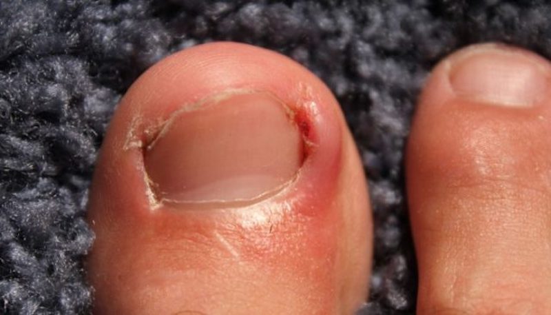 Việc lấy khoé móng chân không đúng cách có thể gây hại cho bạn