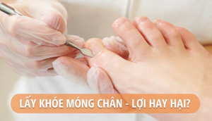 Có nên lấy khóe móng chân không? Cách lấy khóe móng an toàn