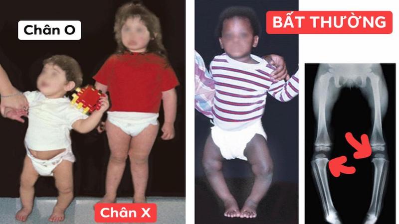 Chân vòng kiềng chữ O và chân X là bình thường, và nếu khi gặp các bất thường về trục xương khi chụp X-quang thì cần nhờ đến sự hỗ trợ của bác sĩ