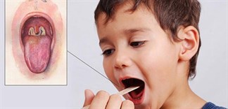 Bạch hầu là bệnh nguy hiểm, không nên chủ quan