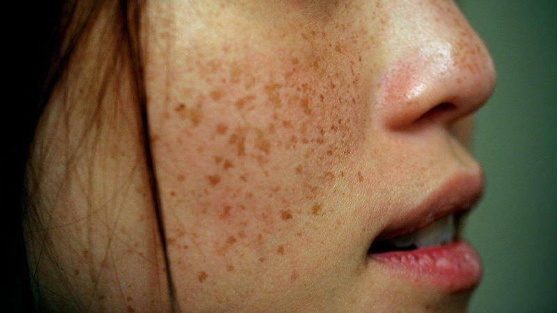 Tàn nhang: là các đốm nhỏ trên da từ 1-5mm, thường hay xuất hiện trên má hay sống mũi
