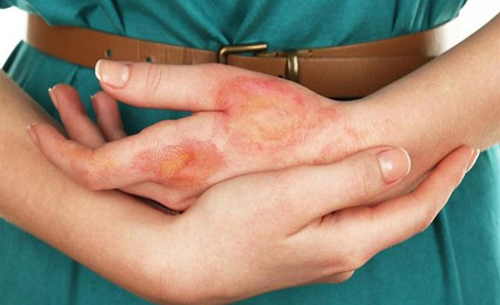 Cảnh báo gây bỏng