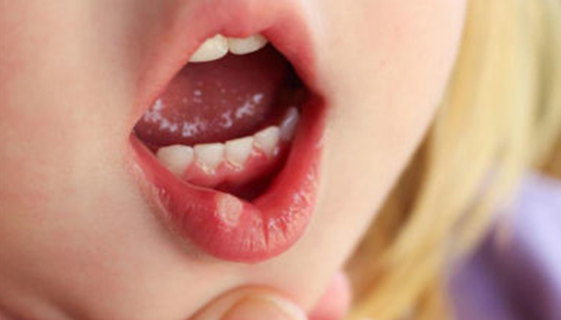 Những tác hại của thói quen cắn môi?