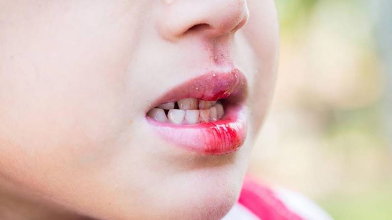 Cách khắc phục thói quen cắn môi