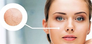 Cách chăm sóc da thiếu nước, thiếu ẩm hiệu quả