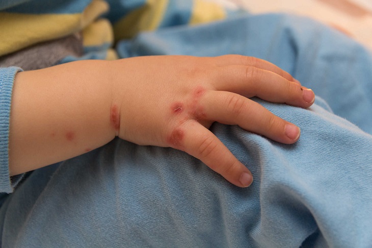 Cách xử lý vết đốt khi trẻ bị muỗi cắn