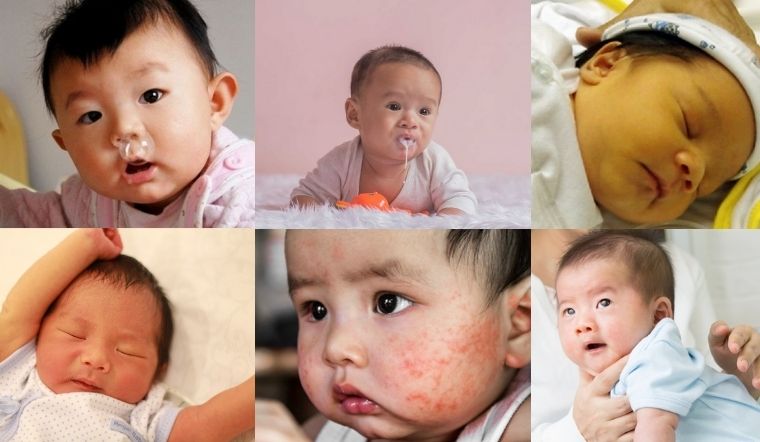 Những hiện tượng sinh lý ở trẻ tưởng là bệnh nhưng thật ra là bình thường