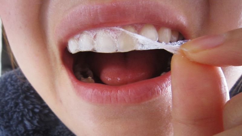 Sử dụng miếng dán làm trắng răng