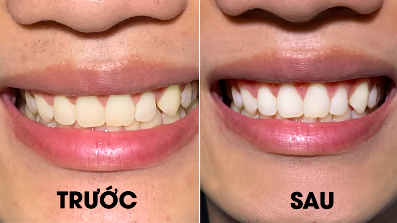 Tẩy trắng răng sâu có được không? Có an toàn và hiệu quả?