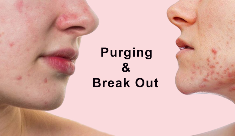 Nên làm gì khi da đang trong giai đoạn "purging" và "break out"?
