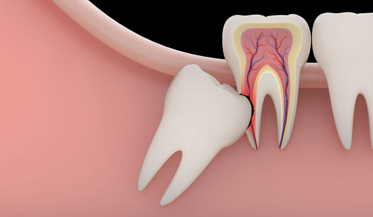 Răng khôn thường mọc trong giai đoạn từ 18-30 tuổi