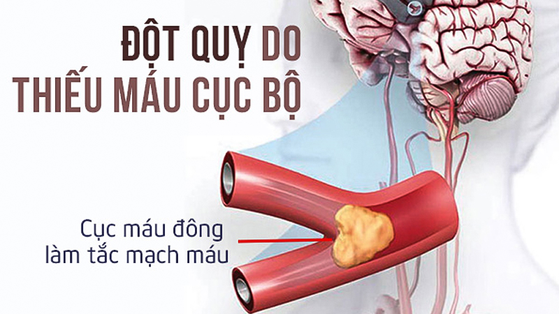 Đột quỵ cho thiếu máu cục bộ