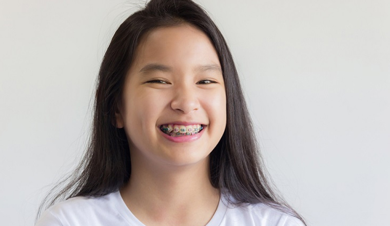 Cha mẹ nên cho con niềng răng từ mấy tuổi?