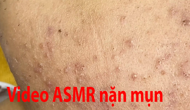 Tổng hợp những video ASMR nặn mụn cực hay, xem bao "đã"