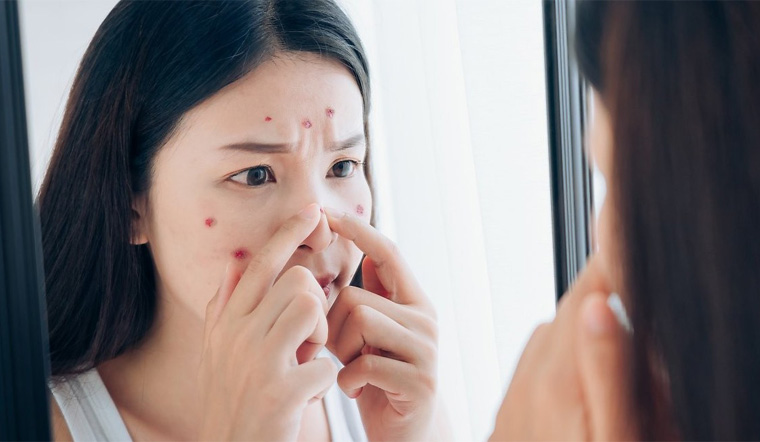 Bác sỹ đưa ra những vùng 'tử thần' tuyệt đối không nên nặn mụn