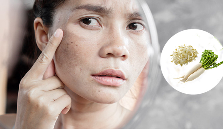 Nám, tàn nhang mấy cũng hết chỉ với 2 nguyên liệu "rẻ bèo"