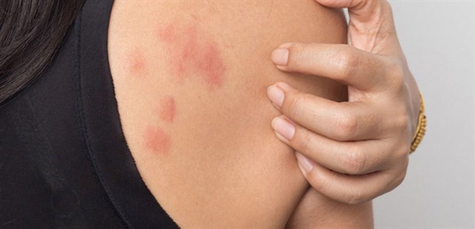 Dị ứng thời tiết là gì, có nguy hiểm không? Nguyên nhân, triệu chứng và cách chữa trị ai cũng cần biết